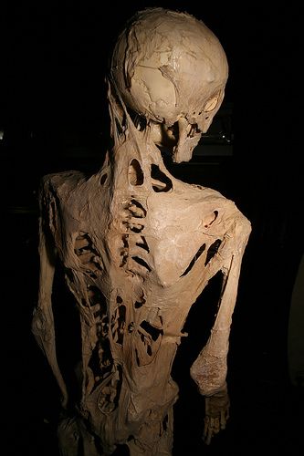 fibrodysplasia ossificans progressiva in newborn