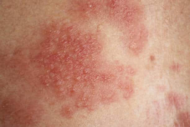 diseases associated with eczema